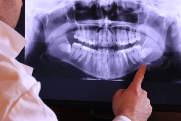 Best Emergency Tooth Extraction in Lucedale, MS